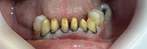 laboratorio dental piccini | laboratorio digital para odontólogos salud | odontologia | odontologos en valdez 166, venado tuerto, santa fe