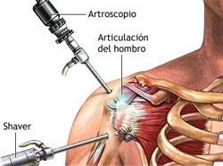 HOMBRO DOLOROSO, DRA MAZZOGLIO TERESA, Venado Tuerto
