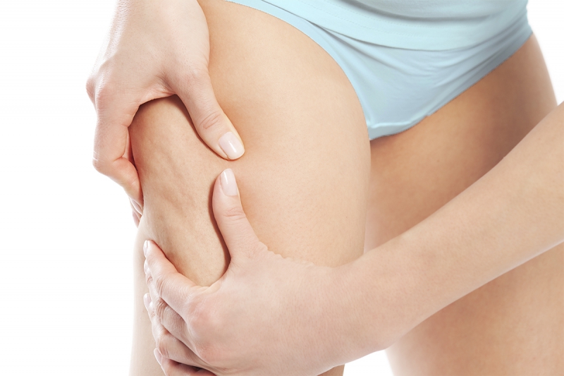 CELULITIS, Dra Natalia Rodriguez , venado tuerto